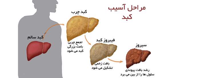 کبد چرب در کمین شکم گنده ها