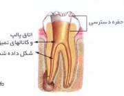 مراحل عصب کشی دندان(با تصاویر)