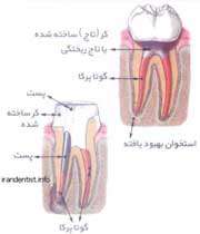 مراحل عصب کشی دندان(با تصاویر)