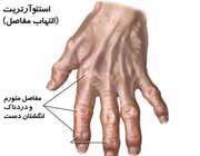 التهاب مفاصل انگشتان دست