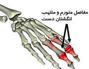 التهاب مفاصل