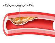 پلاک در ديواره سرخرگ
