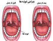 جراحی لوزه ها