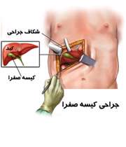 جراحی سنگ کیسه صفرا