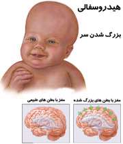 کیست در مغز نوزاد