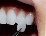 نتیجه تصویری برای روکش دندان
