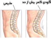 گودی کمر بیش از حد و طبیعی
