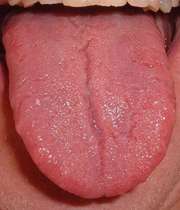 درمان جوش ته زبان