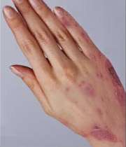 درباره انواع حساسيت پوستي بيشتر بدانيد