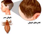 شپش سر