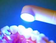 هزینه و قیمت پر کردن دندان هزینه و تعرفه های دندانپزشکی مسواک پلاسمایی مجله پزشکی پر کردن دندان با لیزر پر کردن دندان با کامپوزیت بهداشت دهان و دندان