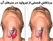 جراحی و برداشتن قسمتی از غده تیروئید