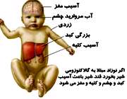 بیماری گالاکتوزومی