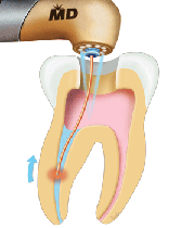 لیزر، گزینه‌ای موثر و ایمن در دندانپزشکی(3)