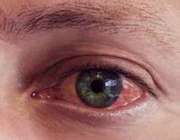 قرمزی و عفونت چشم