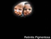 رنگدانه ای شدن شبکیه چشم یا retinitis pigmentosa