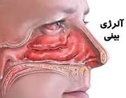 حساسیت یا آلرژِی بینی