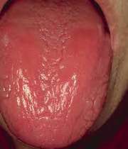 التهاب‌ حاد زبان, کم‌خونی‌, آلرژیهای غذایی