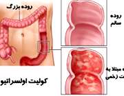 بیماری کولیت اولسراتیو یا التهاب روده زخمی 1