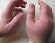 ورم و قرمزی پوست در اثر نیش زنبور