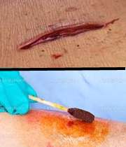 زخم پوستی و بتادین