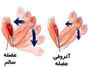 آتروفی عضلات