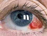 لکه خونی در چشم 1