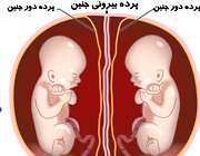 بارداری دوقلویی