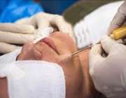 تزریق ژل به صورت