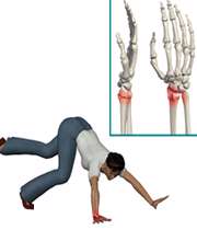 شکستگی استخوان مچ دست