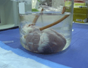 انواع پیوند و مشکلات سیستم ایمنی