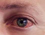 ویروس چشمی