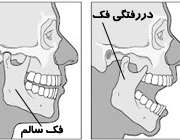 دررفتگی فک صورت