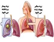 پیوند ریه