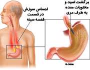 ریفلاکس معده