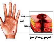 عفونت زخم پوست