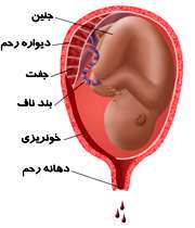 خونریزی بارداری