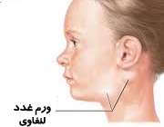 ورم غدد لنفاوی گردن