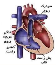 تنگی دریچه ریوی قلب؛ تشخیص و درمان 1