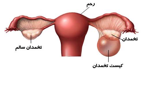 Image result for ‫کیست تخمدان‬‎