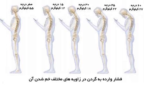 سندرم گردن پیامکی