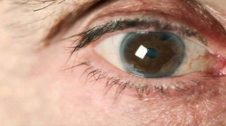 بیماری چشمی آب سیاه
