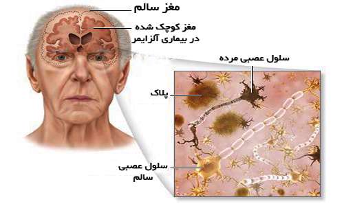 بیماری آلزایمر