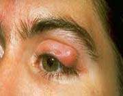 blepharitis