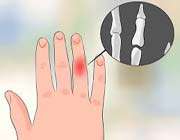jammed finger