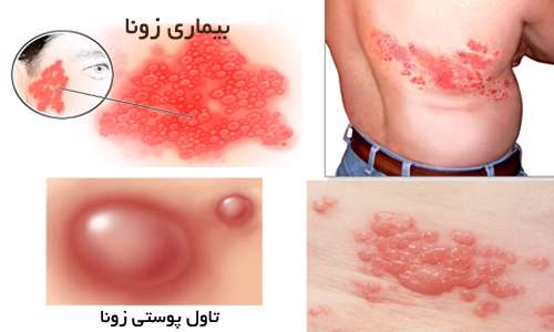 بیماری زونا