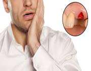 how to treat (and prevent) dry socket naturally
