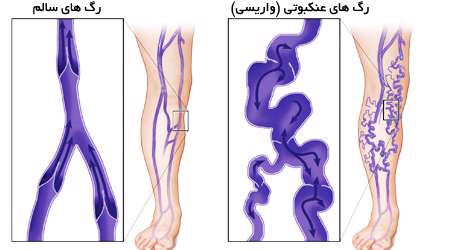 رگ های عنکبوتی یا واریسی پا