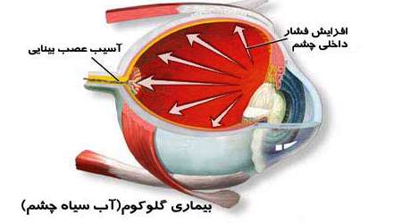 بیماری آب سیاه چشم