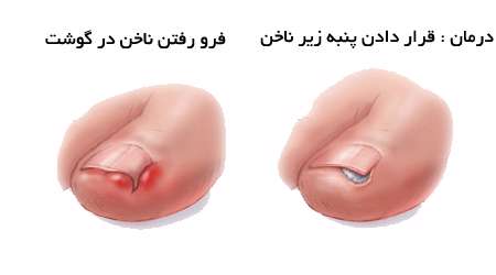 فرور فتن ناخن در گوشت